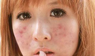 额头上长痘痘怎么调理 额头上长痘痘怎么调理